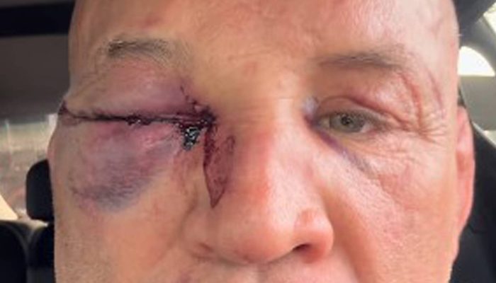 Wanderlei Silva mostra ferimentos no rosto após briga entre a sua equipe e a do boxeador Popó.
             -       
        Reprodução/wandfc no Instagram