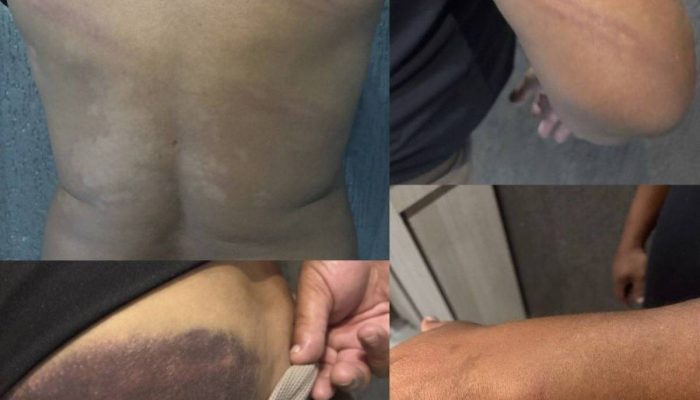 Hematomas no corpo do ex-jogador Perdigão
             -       
        Reprodução/Redes sociais